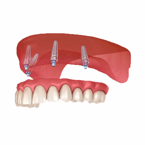 Dantură fixă pe implanturi - Clinică Stomatologică Chișinău