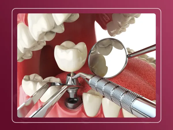 Этапы лечения с имплантацией зубов – От консультации до идеальной улыбки