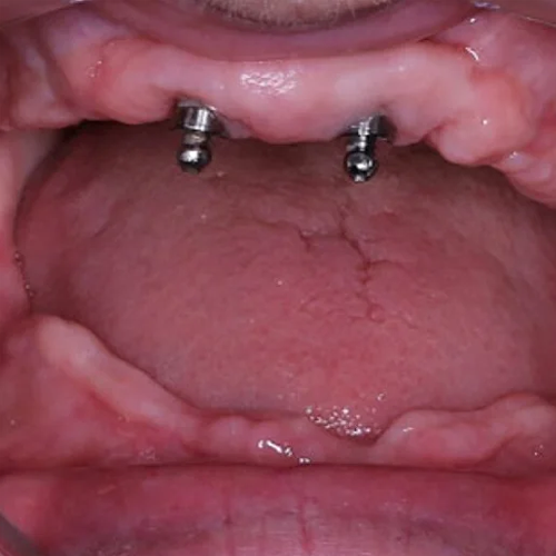 Resorbția osului maxilar - Clinică Stomatologică Chișinău Buiucani