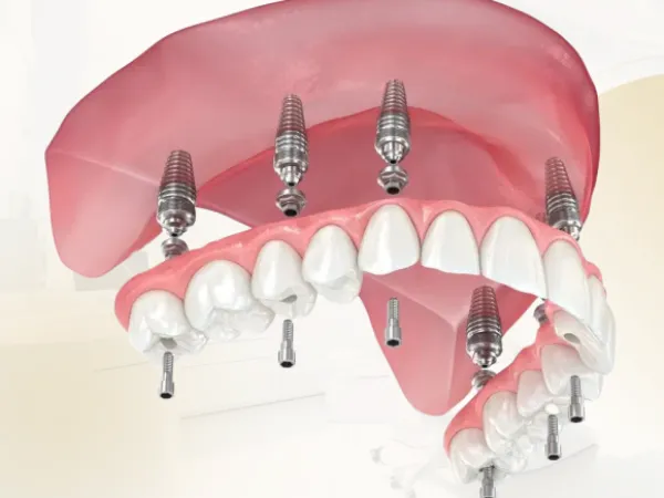 Dantură Fixă pe Implanturi în Chișinău – Soluția Completă la FaurDent